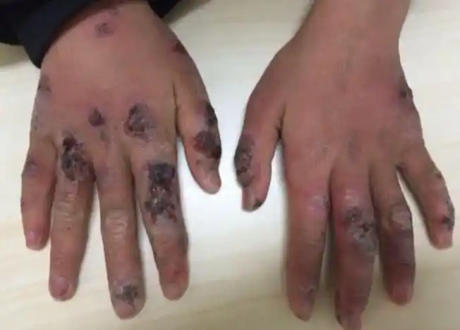 心痛!宝宝双手烂成这样,妈妈难辞其咎