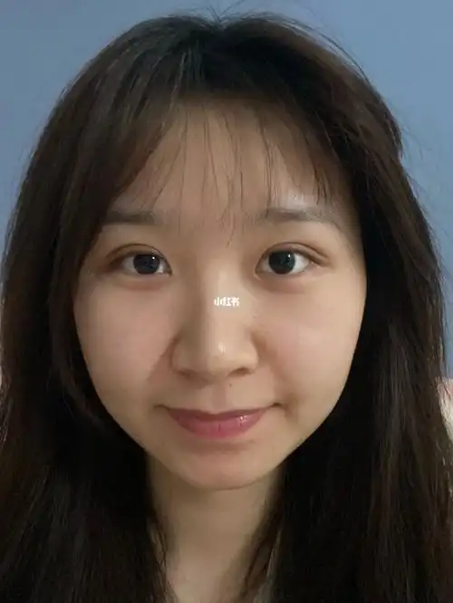 双眼皮一个月零九天