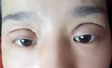 上睑下垂矫正手术方法