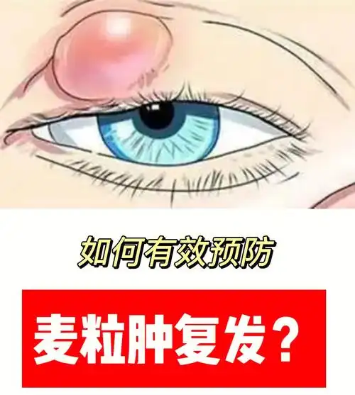 如何有效预防麦粒肿针眼的复发