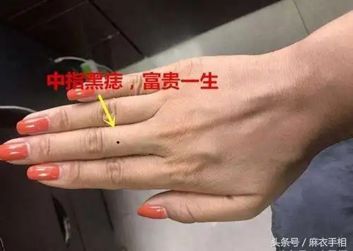 这几个部位出现黑痣, 人中龙凤,迟早出人头地!