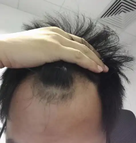 现在就想问问,我这一种掉头发是什么情况,到底还能不能恢复好?
