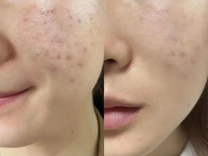 本人油痘肌急需改善皮肤!不想再做油腻邋遢女生了! - 知乎