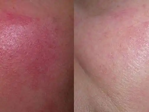 红血丝脸怎么才能治好?对症淡化修复就不难!