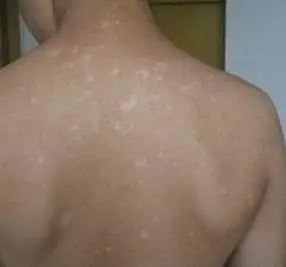 南昌治白癜风的医院 30健康问答_南昌白癜风医院挂号