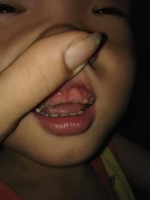 三周岁半了宝宝的牙齿都烂了,怎么回事呀