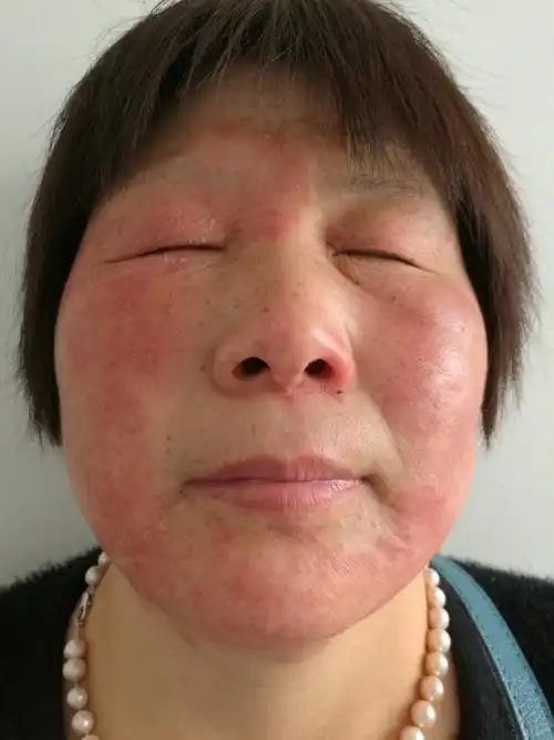 脸红并不一定是过敏_治疗