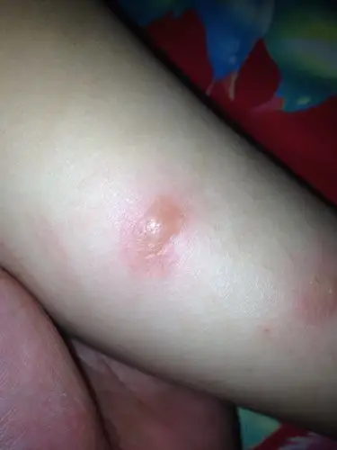 小孩身上长了好多水泡小花生豆大小,发痒,偏僵硬,一抓就破,里面的水