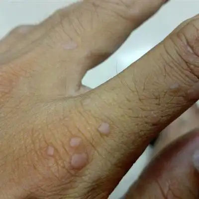 手部扁平疣的症状图