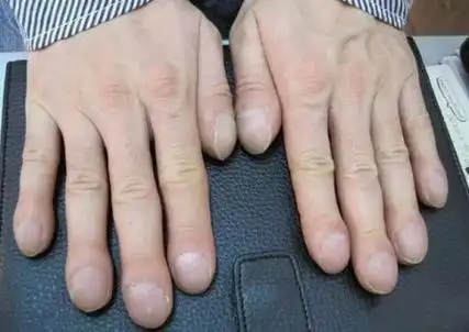 心脏有病,指甲先知?若指甲出现5个征兆,可能是心脏在"报警"