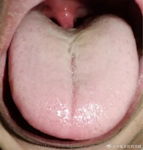 中医##国医的精诚力量##中医舌诊