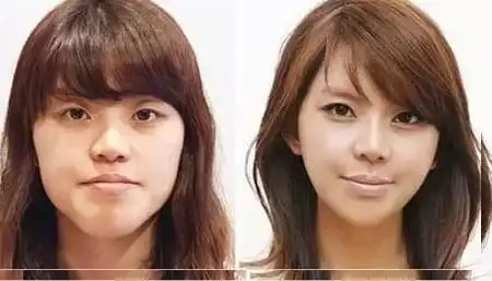 韩国人整容前后的对对比,变化大得亲妈都认不出来!