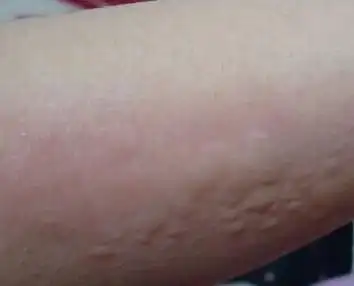 青岛人工荨麻疹的症状及治疗