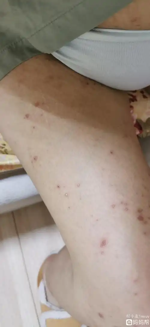 孕妇免疫功能低下,也会花粉过敏孕妇皮肤过敏如何治疗 1食疗 在妊娠