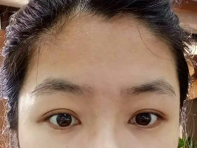 有没有因为额头低而脱发际线的