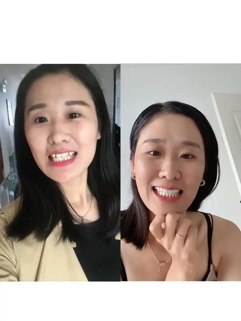 漫漫正畸路.#牙齿正畸##牙齿矫正##牙套毕业# #前后对比 - 抖音