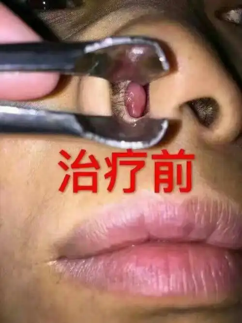 后胡山鼻腔护理中心