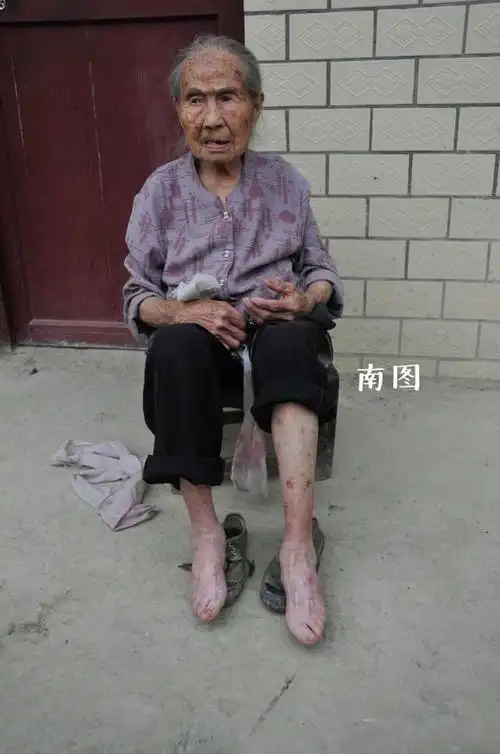 中国最后的三寸金莲 双脚用布紧紧裹住 看着都揪心