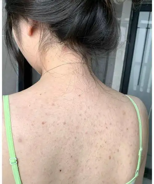 感觉好像我们女生都是后背长痘的居多!
