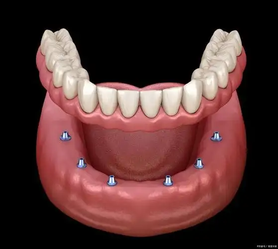 老年人做半口/全口种植牙的两种主流方式