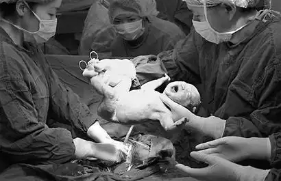 玉树伤员剖腹产下女婴