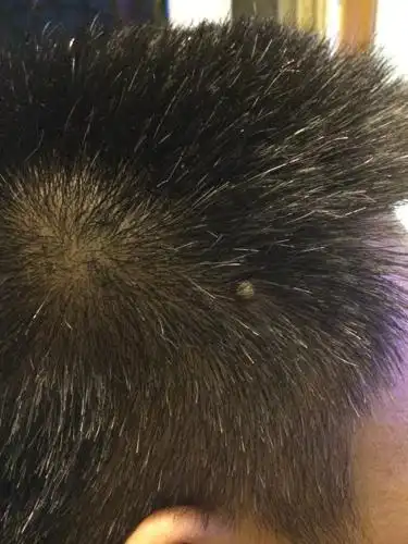 头皮上长了一个这样的东西有很厚的痂是什么?