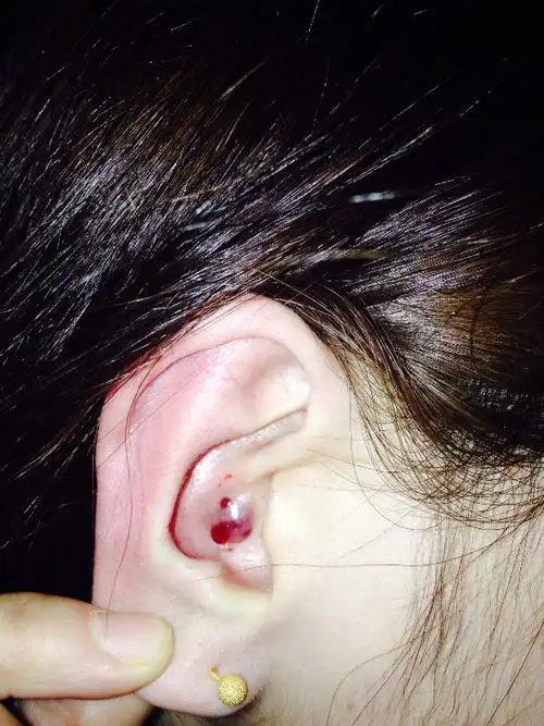 耳廓长了一个脓包 挤出了很多血
