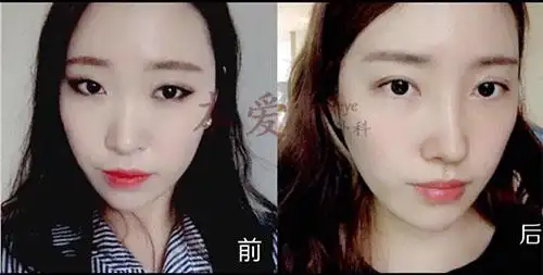 韩国本爱眼睑下至对比