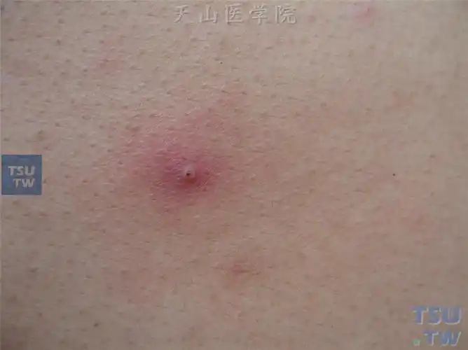 毛囊炎,疖和痈的症状表现