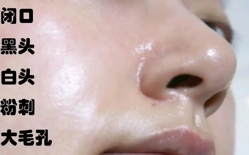 【叨叨喵】闭口黑头粉刺毛孔,护肤心得分享