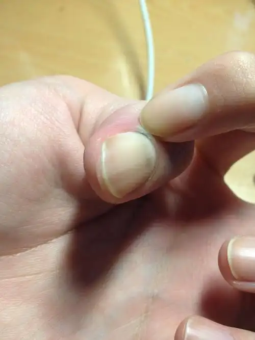 指甲根部有黑色的部分,在指甲与肉的接缝处,是什么原因?有影响么?