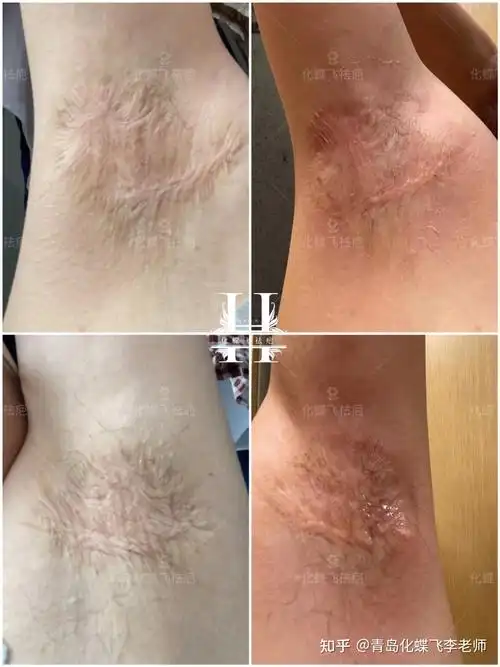 魔都上海,20多年的腋下手术疤痕,小诊所做的手术,缝的乱七八糟和包