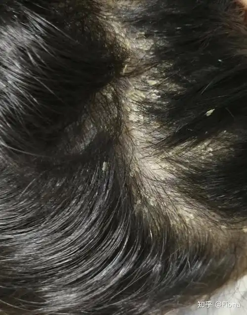 与头部脂溢性皮炎抗战胜利的亲身经历