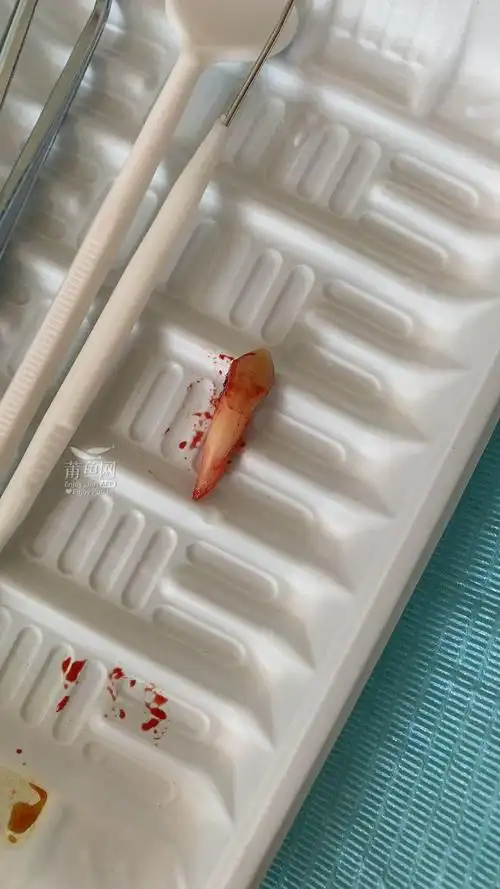 刚刚拔了一颗牙,你们见过这么大这么长这么恶心的虎牙吗