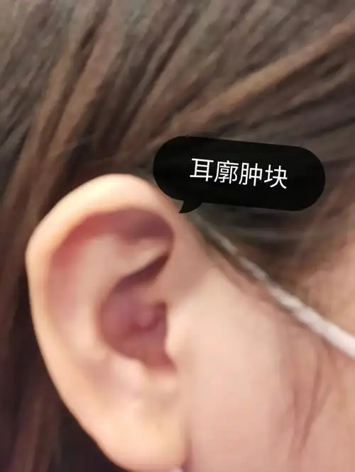 耳廓囊肿肿块不痛不痒不影响听力