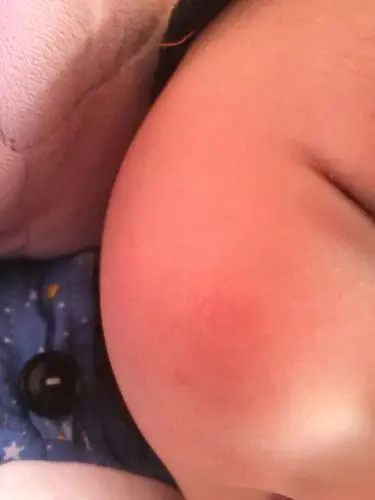 四个多月的宝宝脸上有红血丝怎么办?