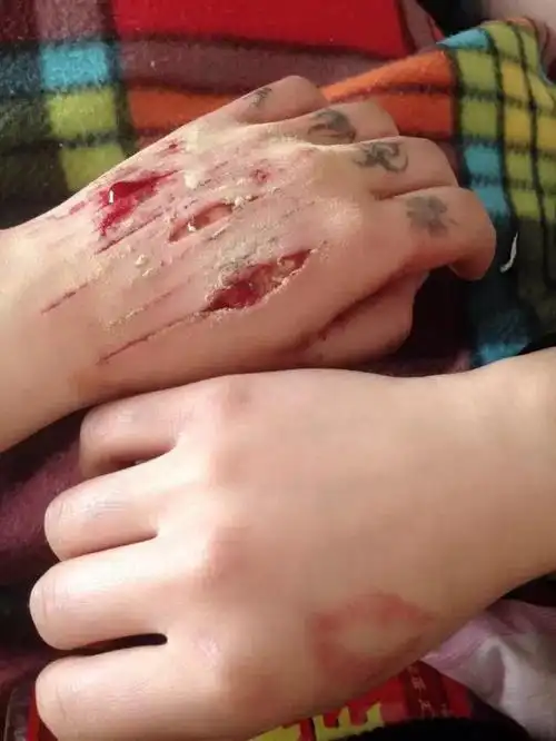 女,一年前因感情纠纷过度自责 给自己造成严重自残