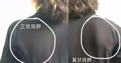 肩胛骨中间竖着垫个毛巾可以卧推时很大原因就是肋骨外翻造成的胸肌