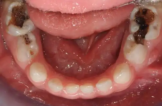 爱护牙齿限糖减酸