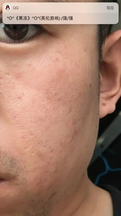 24岁男生,皮肤不好,毛孔粗大,皮肤下还有小痘痘,怎么办呢