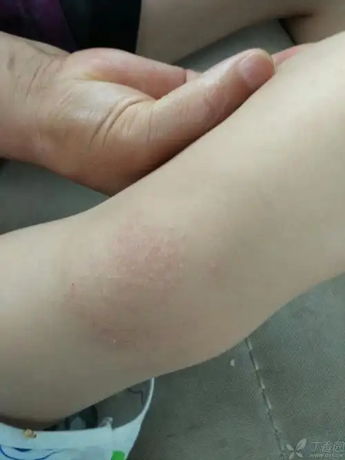 不疼不痒局部皮疹