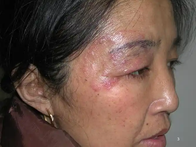 真菌性皮肤病2021完整版课件.ppt