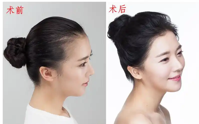 进阶女神你的发际线合格了吗