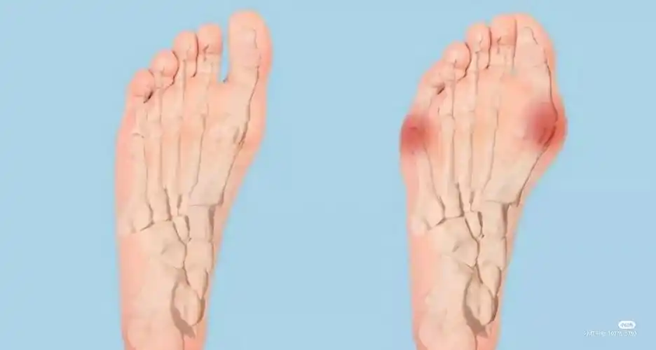 牛江红谈避免大脚骨危害