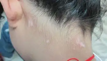 大约是黄豆大小或者一元硬币大小,白斑的发病部位不固定,而且白斑的