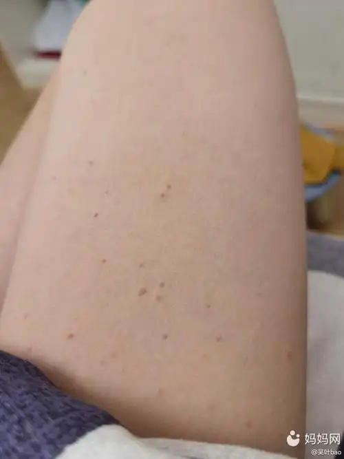身上长了好多红痣,不痛不痒,好担心