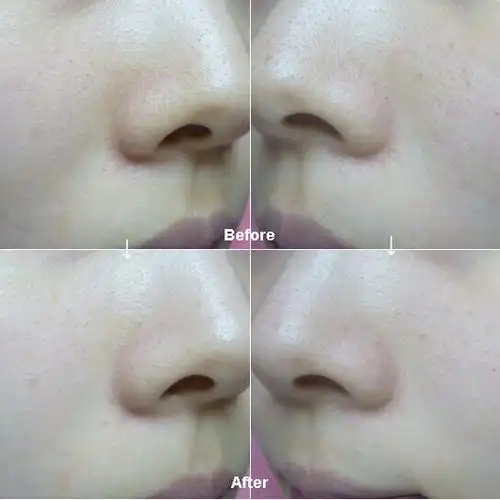 黑脸娃娃收缩面部毛孔前后效果对比