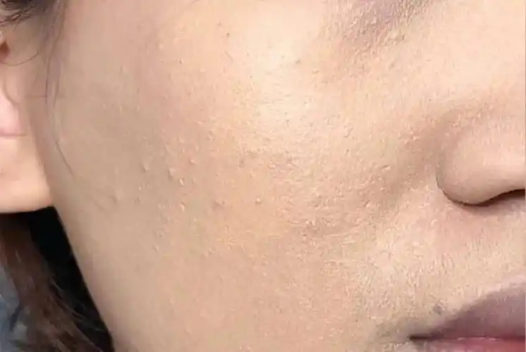 缺水程度自测你的皮肤有多渴