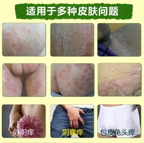 百草阴痒膏 男女外阴内阴部阴囊潮湿包皮龟炎头肛门大腿内侧止痒女性