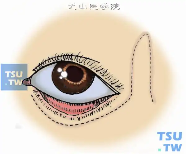 眼睑邻近皮瓣转位术
